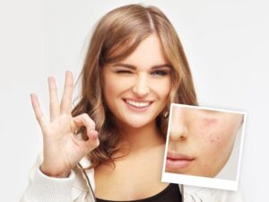 Consejos efectivos para prevenir y eliminar el acné